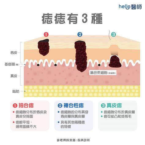 有毛的痣|為什麼臉上的痣越來越多？皮膚科醫師解析長痣原因、。